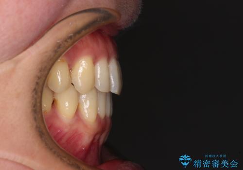 八重歯のインビザライン矯正治療の治療後