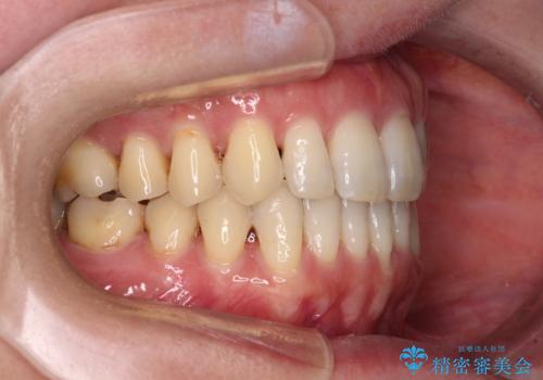 八重歯のインビザライン矯正治療の治療後