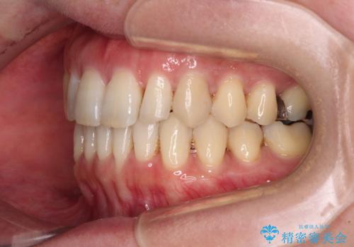 八重歯のインビザライン矯正治療の治療後