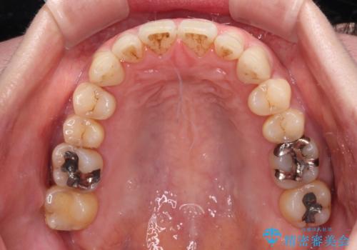 八重歯のインビザライン矯正治療の治療後