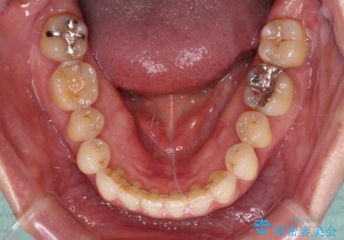 八重歯のインビザライン矯正治療の治療後