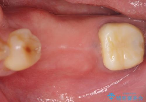 インプラント 失った奥歯の欠損補綴の治療前
