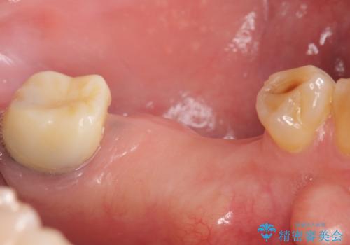 インプラント 失った奥歯の欠損補綴の治療前