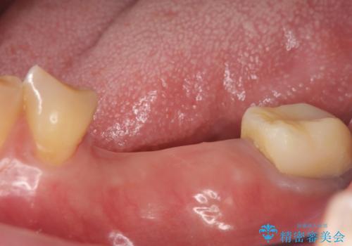インプラント　失った奥歯の欠損補綴の治療前