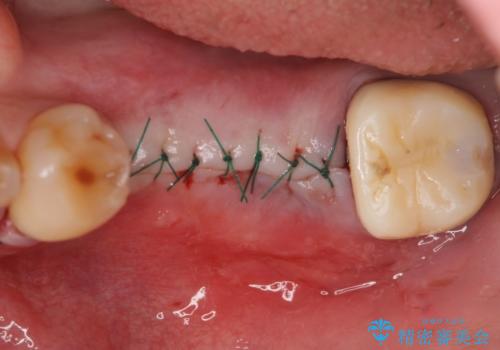インプラント 失った奥歯の欠損補綴の治療後