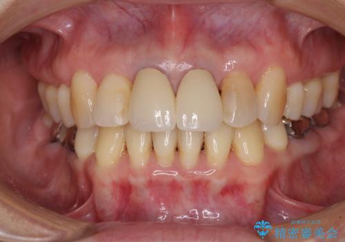 部分矯正とセラミック 前歯の審美治療の症例 治療後