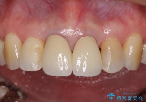 部分矯正とセラミック 前歯の審美治療の治療後