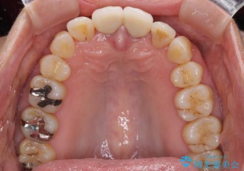 部分矯正とセラミック　前歯の審美治療の治療後