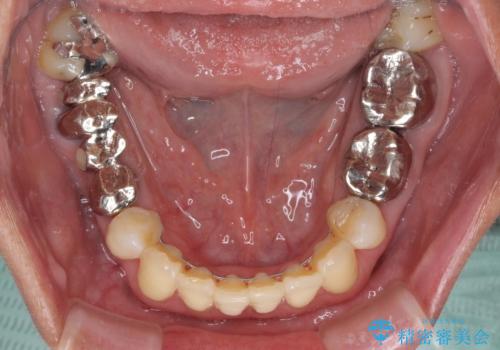 部分矯正とセラミック　前歯の審美治療の治療後