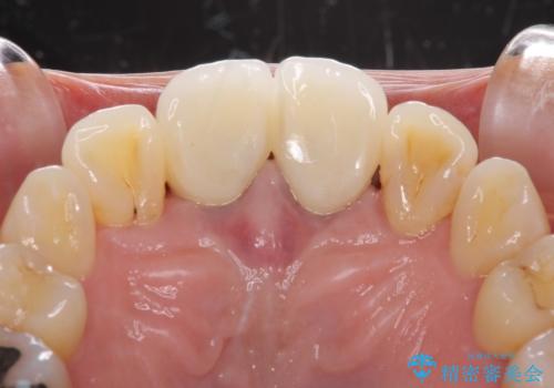 部分矯正とセラミック 前歯の審美治療の治療後