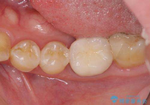 冷たいものがしみる セラミックインレーによるむし歯治療の治療後