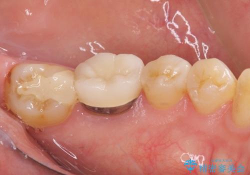 冷たいものがしみる セラミックインレーによるむし歯治療の治療後
