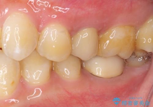 冷たいものがしみる セラミックインレーによるむし歯治療の治療後