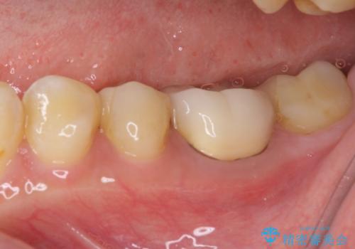 冷たいものがしみる セラミックインレーによるむし歯治療の治療後