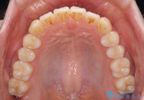 オープンバイトでかみにくい　インビザラインによる矯正治療の治療後
