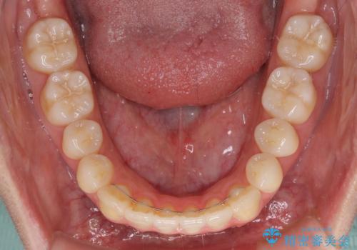 オープンバイトでかみにくい　インビザラインによる矯正治療の治療後