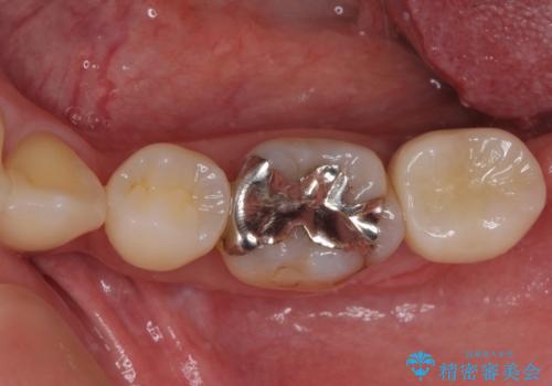 歯周病で抜歯に　奥歯のインプラント治療