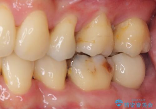 歯周病で抜歯に　奥歯のインプラント治療の治療後