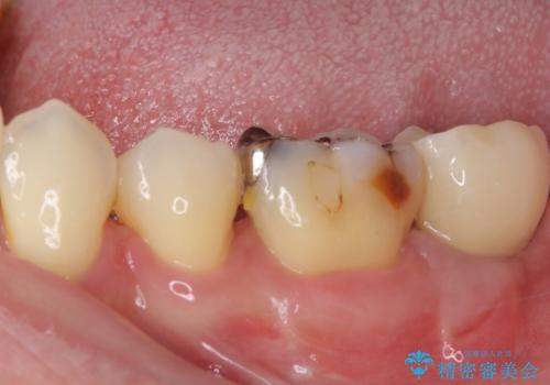 歯周病で抜歯に　奥歯のインプラント治療の治療後