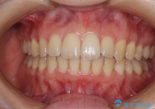 前歯のデコボコを解消　インビザラインによる矯正治療