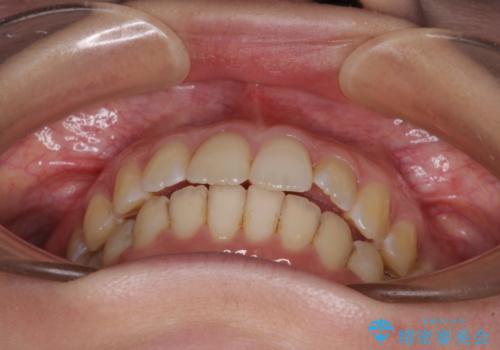 前歯のデコボコを解消 インビザラインによる矯正治療の治療後