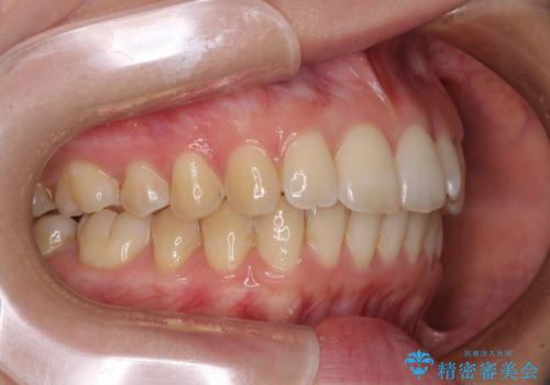 前歯のデコボコを解消 インビザラインによる矯正治療の治療後