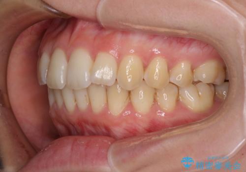 前歯のデコボコを解消　インビザラインによる矯正治療の治療後