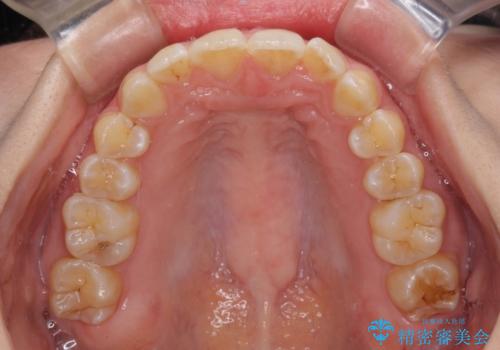 前歯のデコボコを解消 インビザラインによる矯正治療の治療後