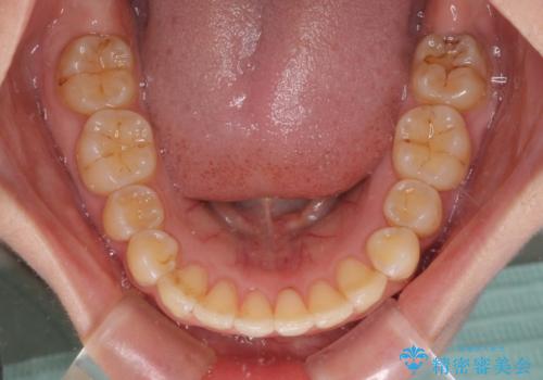 前歯のデコボコを解消 インビザラインによる矯正治療の治療後