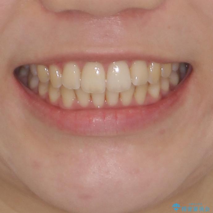 前歯のデコボコを解消　インビザラインによる矯正治療の治療後（顔貌）