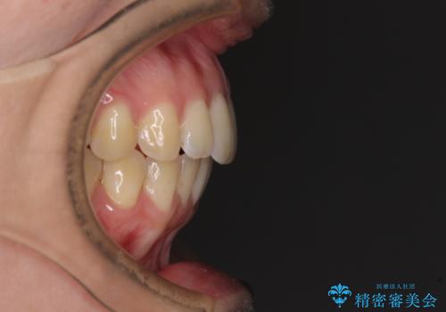 前歯のデコボコを解消 インビザラインによる矯正治療の治療後