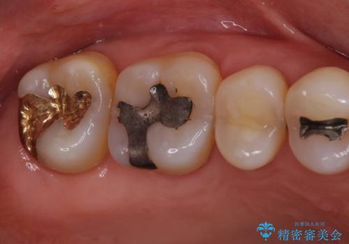 銀歯の中が虫歯になった ゴールドインレーによる修復治療の治療後