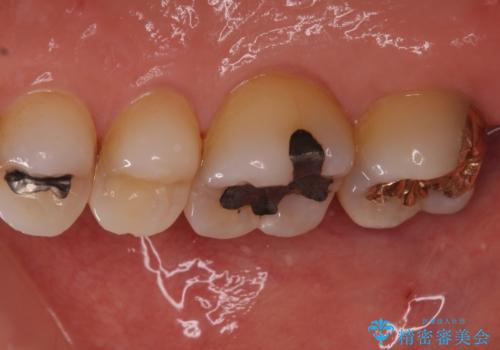 銀歯の中が虫歯になった ゴールドインレーによる修復治療の治療後