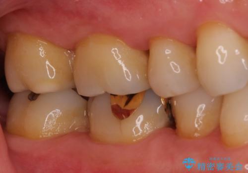 銀歯の中が虫歯になった ゴールドインレーによる修復治療の治療後