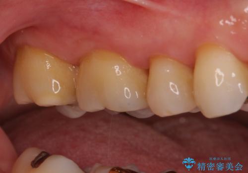 奥歯の虫歯　ゴールドインレーによる修復治療の治療後