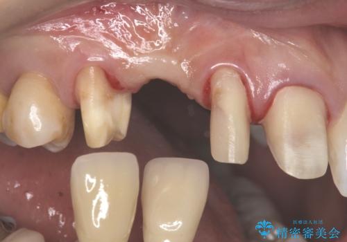 前歯の虫歯 とりあえずつけていた歯がとれたの治療中