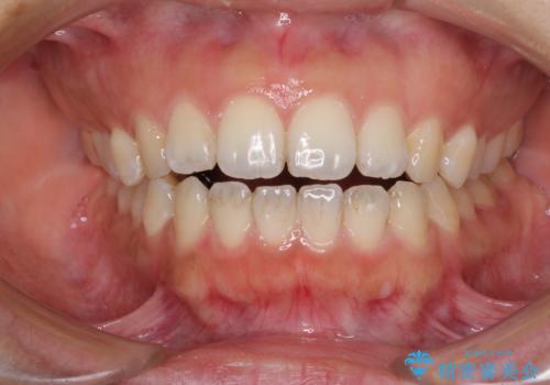 全く目立たないワイヤー矯正 上下リンガル矯正の治療中