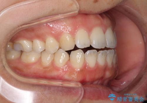 全く目立たないワイヤー矯正 上下リンガル矯正の治療中