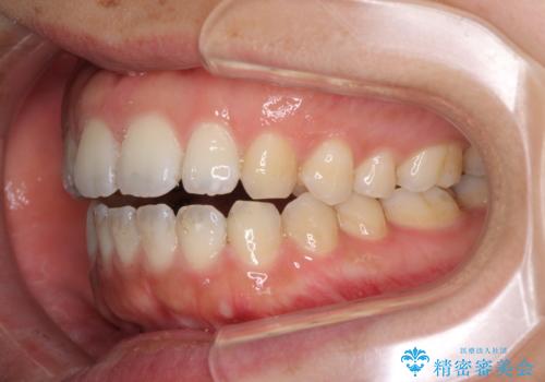 全く目立たないワイヤー矯正 上下リンガル矯正の治療中
