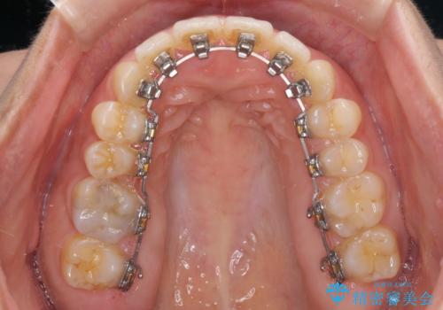 全く目立たないワイヤー矯正 上下リンガル矯正の治療中