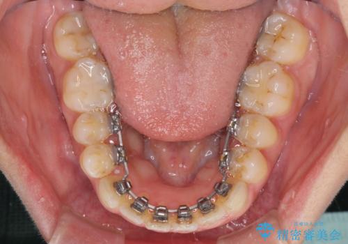 全く目立たないワイヤー矯正 上下リンガル矯正の治療中
