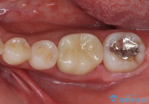 奥歯の虫歯　オールセラミッククラウンによる補綴治療の治療後