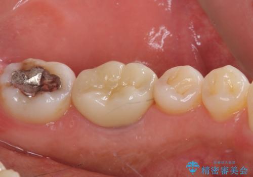 奥歯の虫歯 オールセラミッククラウンによる補綴治療の治療後