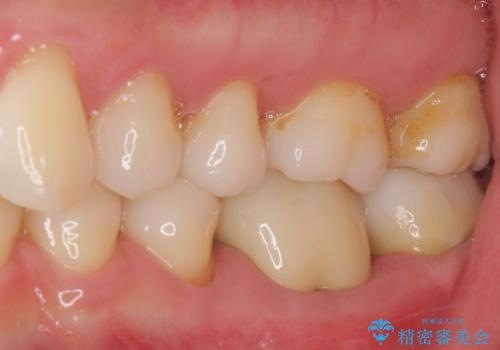 奥歯の虫歯　オールセラミッククラウンによる補綴治療の治療後