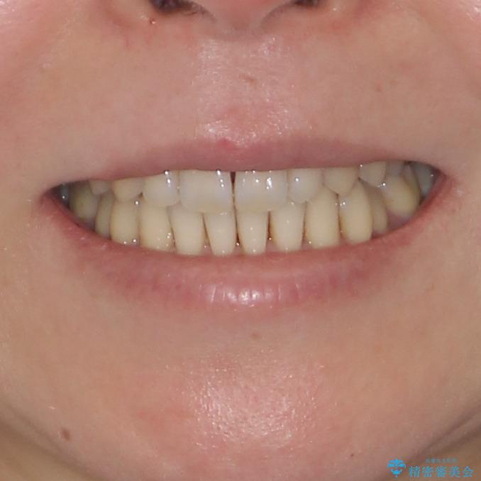 八重歯のインビザライン矯正治療の治療後（顔貌）