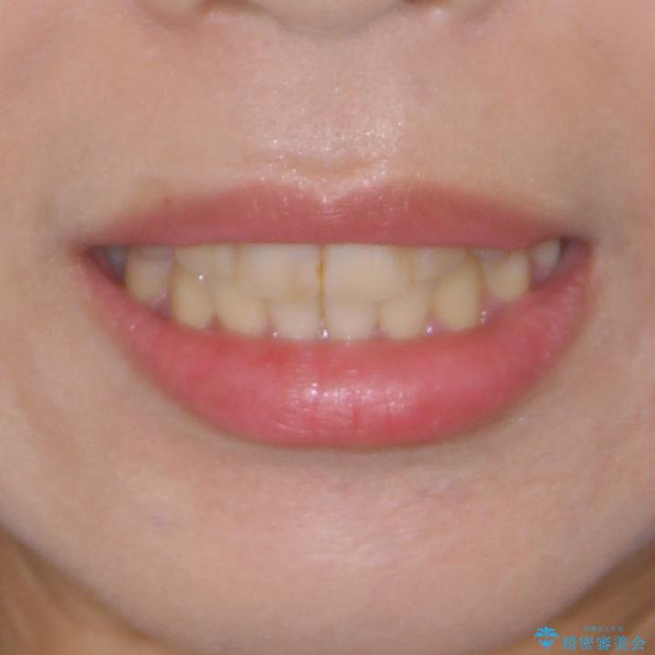 上下の八重歯を治したい　インビザラインと補助装置を用いた抜歯治療の治療後（顔貌）