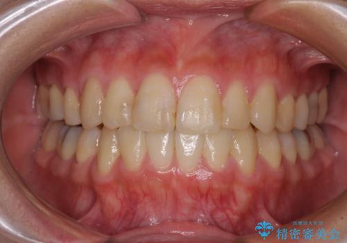 上下の八重歯を治したい　インビザラインと補助装置を用いた抜歯治療