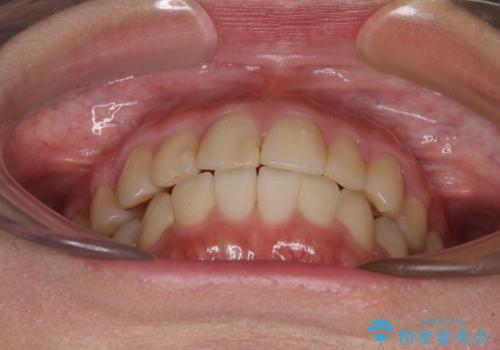 上下の八重歯を治したい　インビザラインと補助装置を用いた抜歯治療の治療後