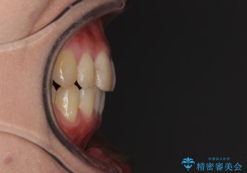 上下の八重歯を治したい インビザラインと補助装置を用いた抜歯治療の治療後