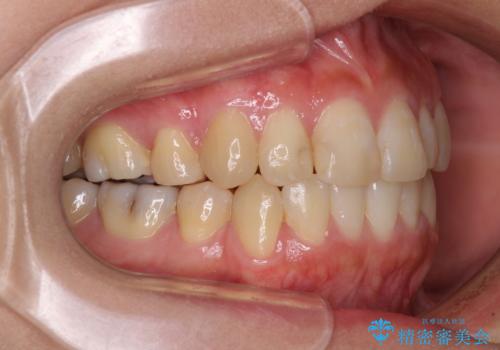 上下の八重歯を治したい インビザラインと補助装置を用いた抜歯治療の治療後